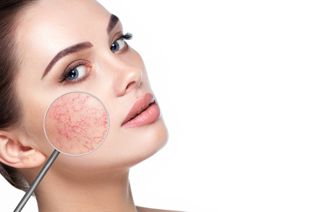 Understanding Rosacea: Symptoms, Triggers, and Skincare Tips