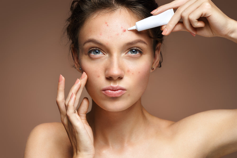 A Clear Guide On How to Prevent Acne