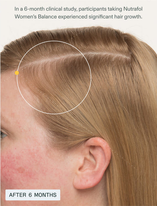 After 6 months: Results of a clinical study showing significant hair growth and increased density in a woman using Nutrafol Women's Balance.