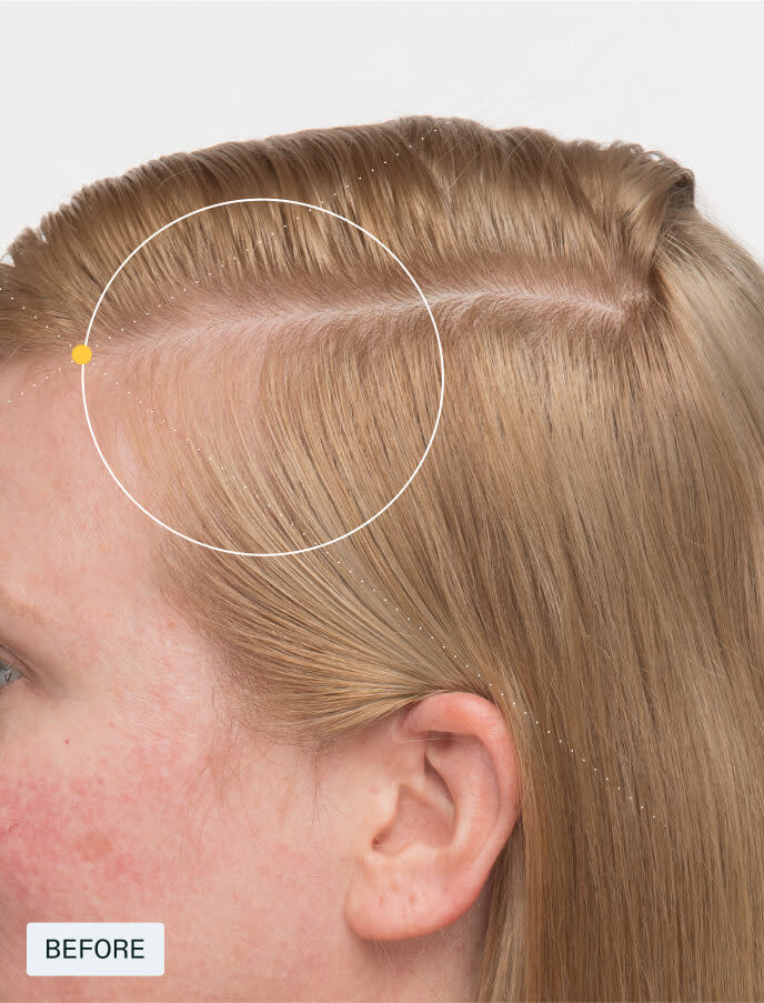 Before photo showing visible scalp and hair thinning at the hairline and part before using Nutrafol Women’s Balance.