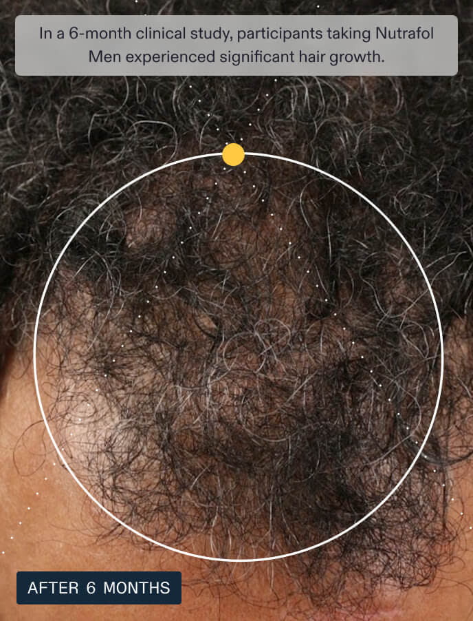 Results of a 6-month clinical study for Nutrafol Men showing significant hair regrowth and improved scalp coverage for men with thinning hair.