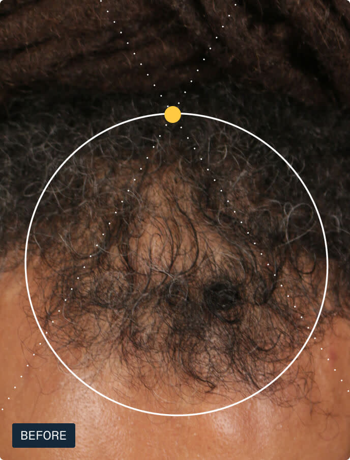 Before photo of a man’s scalp showing visible thinning at the crown and vertex before starting Nutrafol Men hair growth supplements.