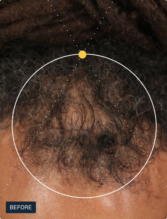 Before photo of a man’s scalp showing visible thinning at the crown and vertex before starting Nutrafol Men hair growth supplements.