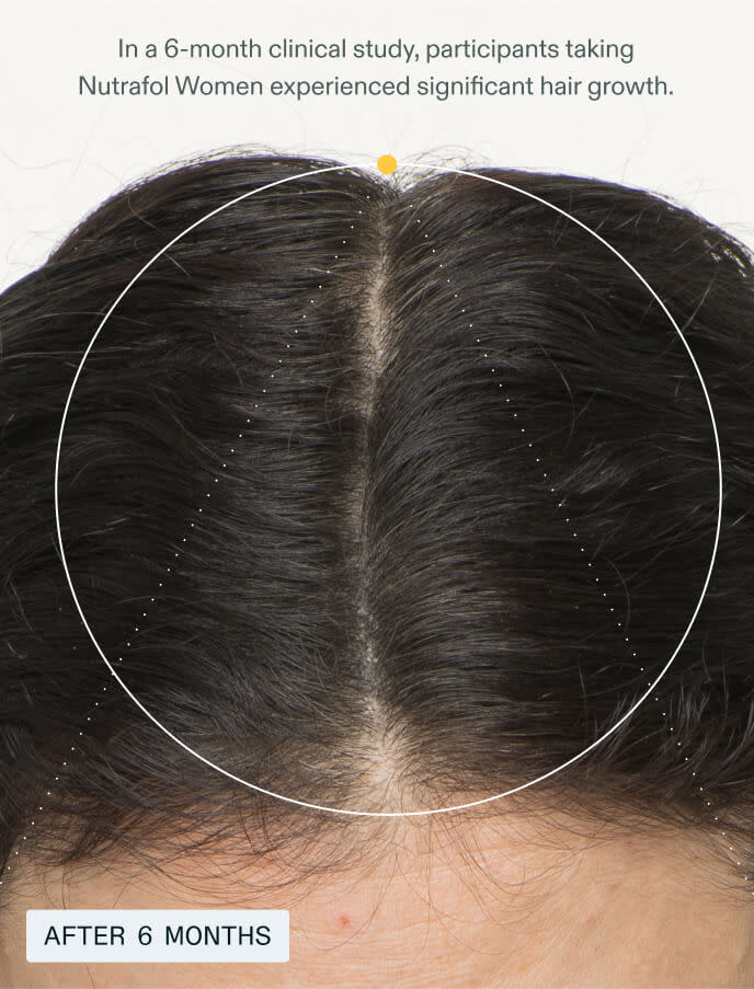 Top view of a woman’s scalp after 6 months of using Nutrafol Women, showing visible hair growth and a narrowed part line.