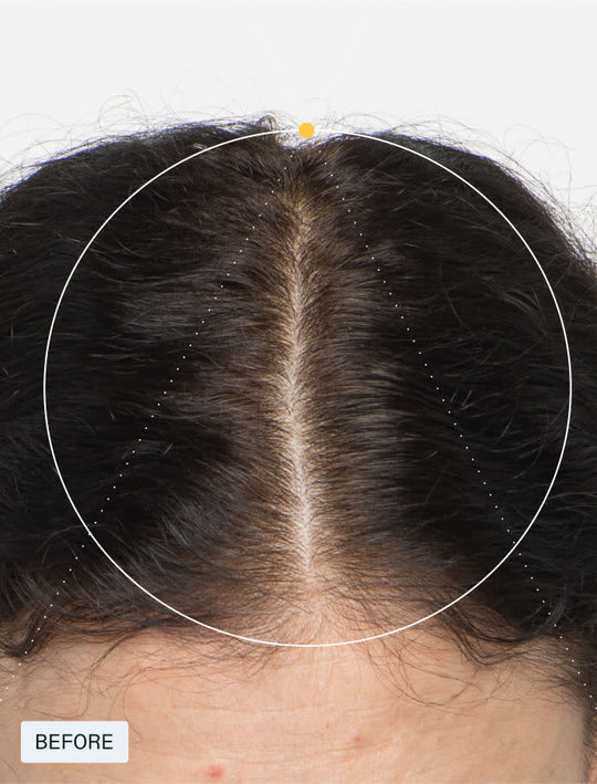 Before photo of a woman’s scalp showing thinning hair and a wide part before starting Nutrafol Women hair growth supplements.